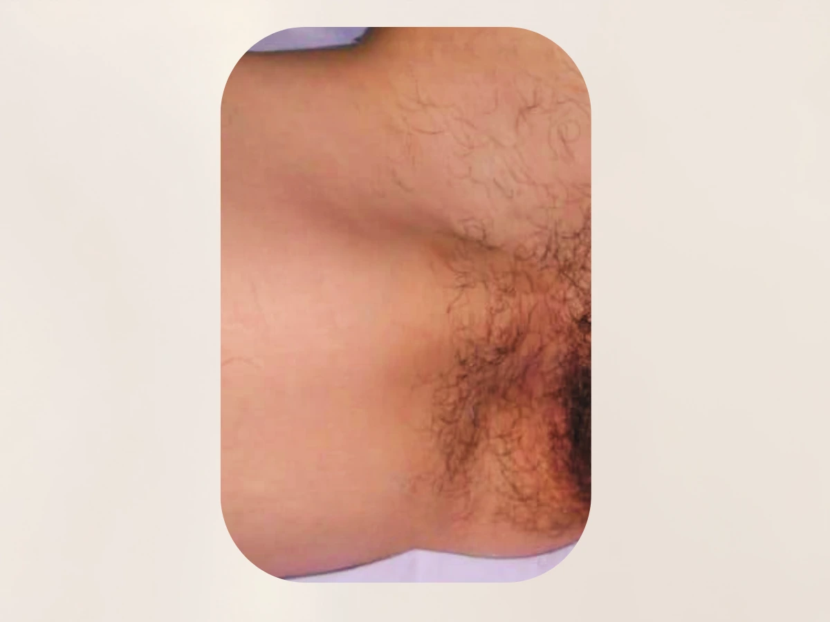 Epilazione laser bikini prima del percorso IUVES